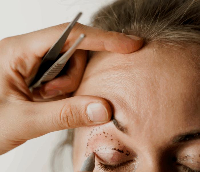 Blépharoplastie ophtalmologique
