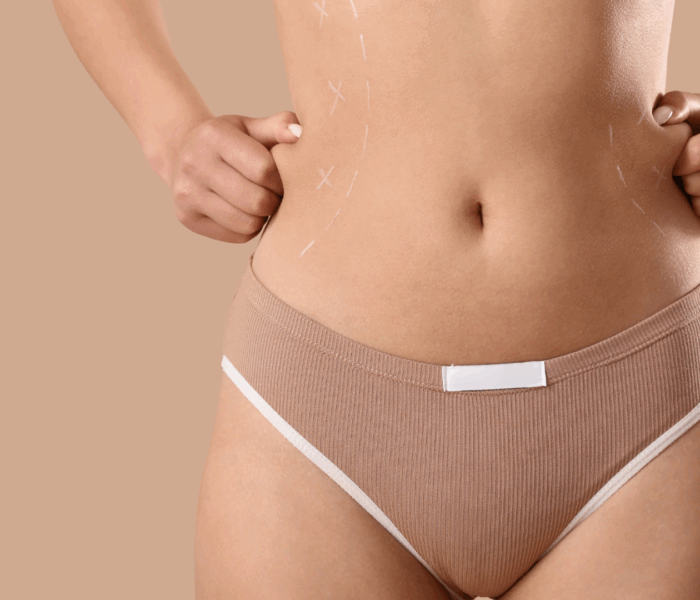 Bodylift