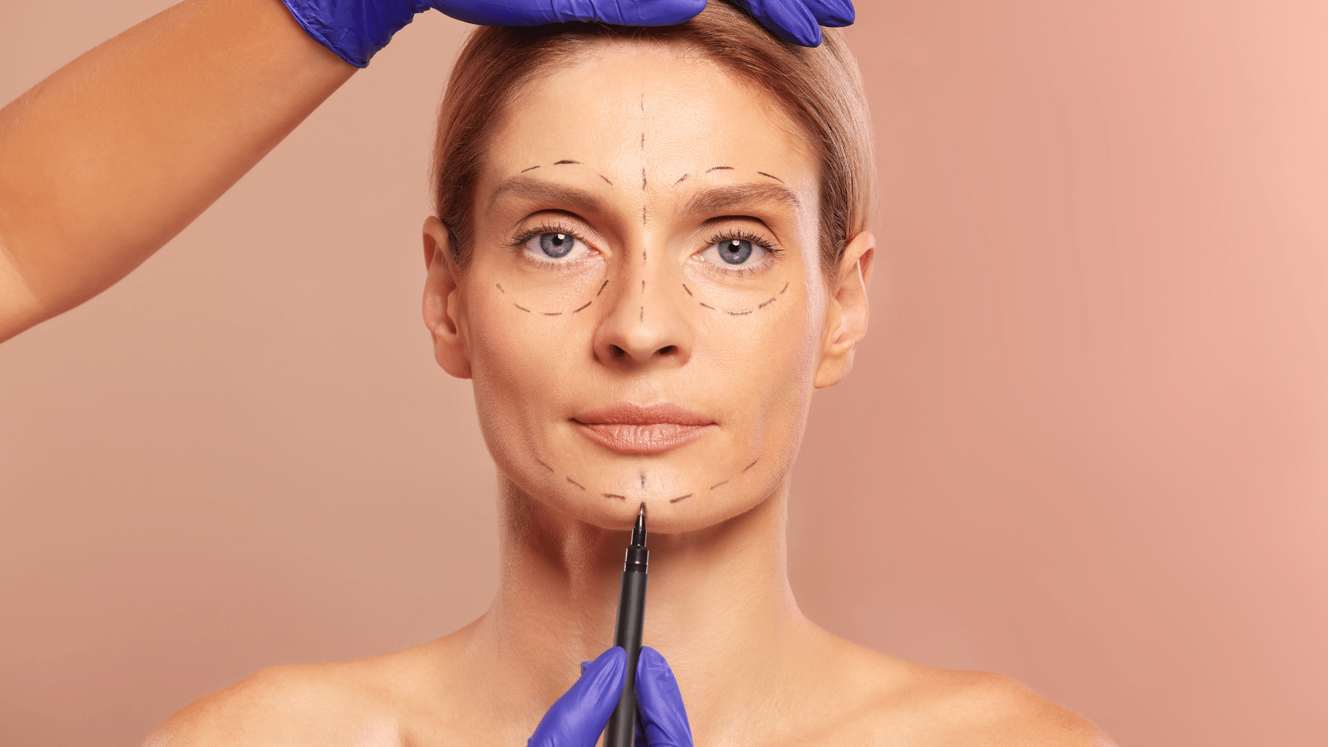 Génioplastie
