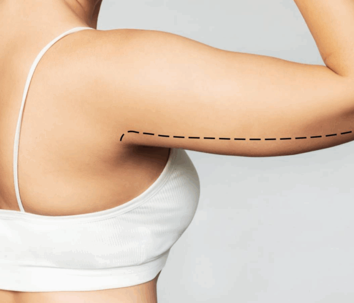 Lifting des bras (brachioplastie)