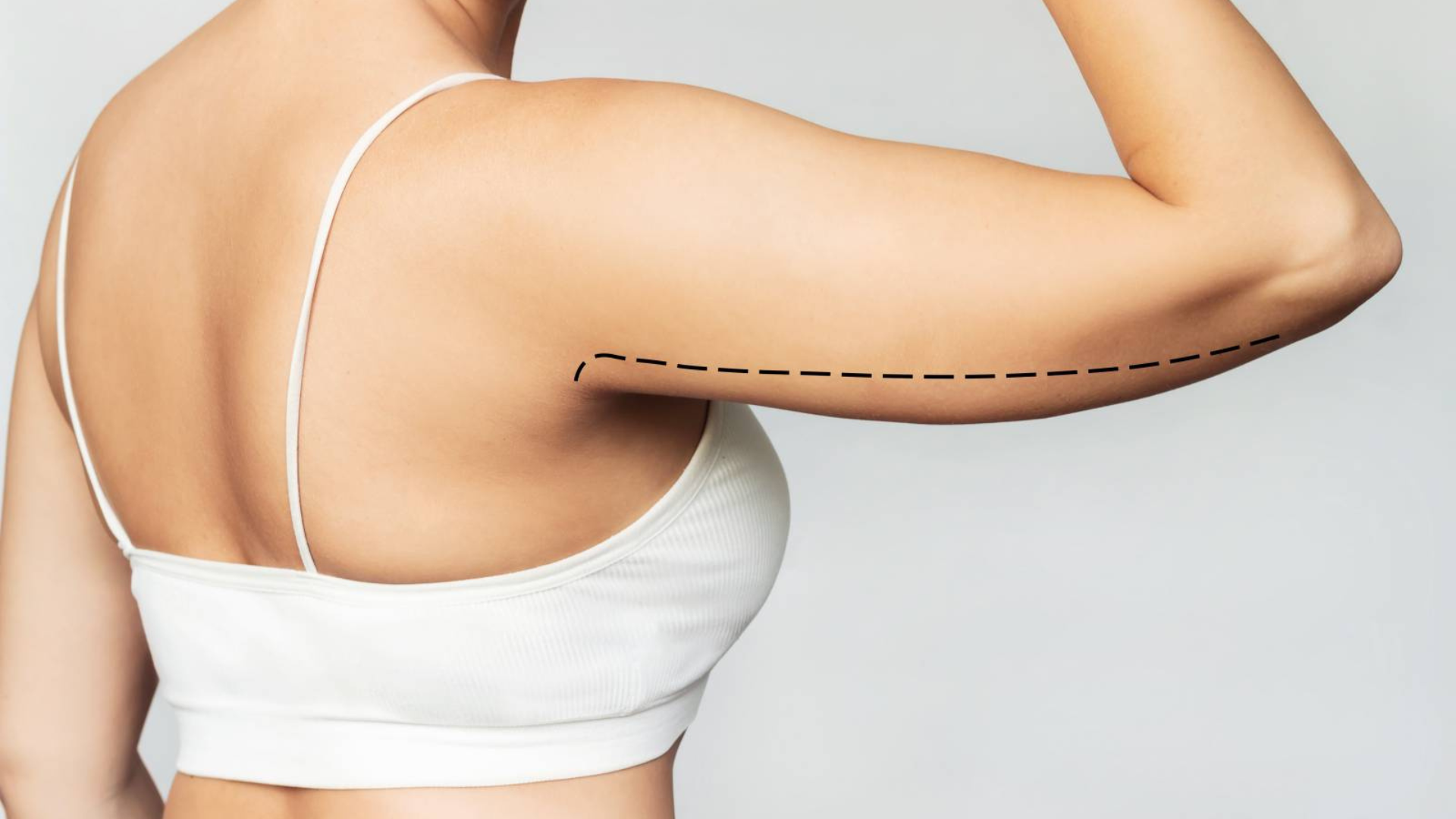 Lifting des bras (brachioplastie)