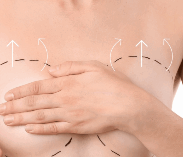 Lipofilling mammaire