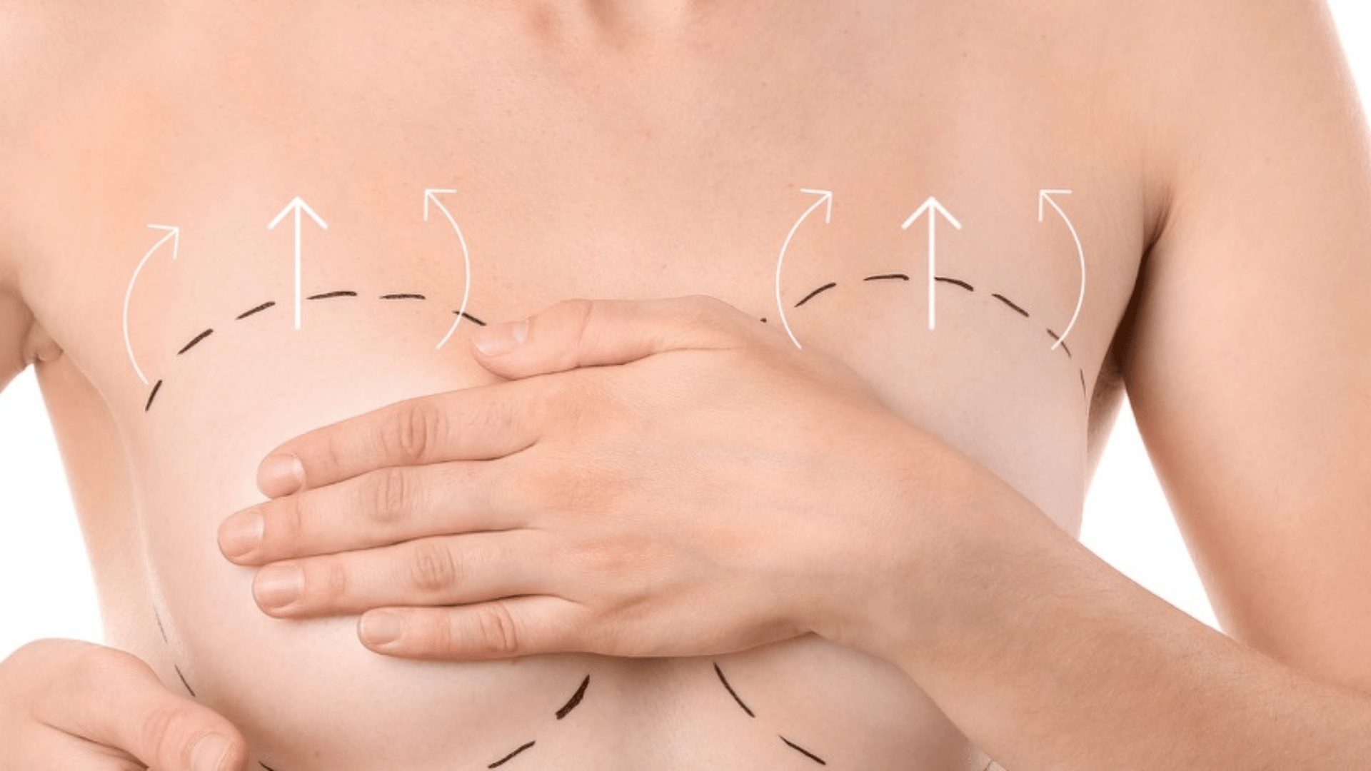 Lipofilling mammaire