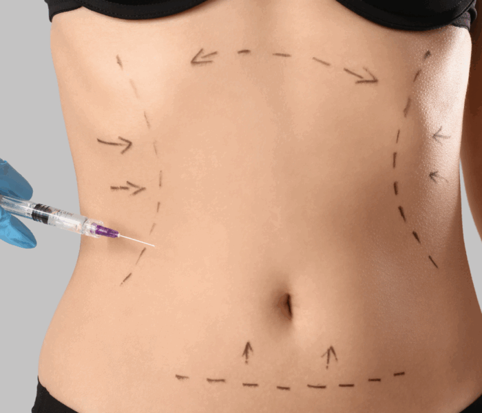 Liposuccion
