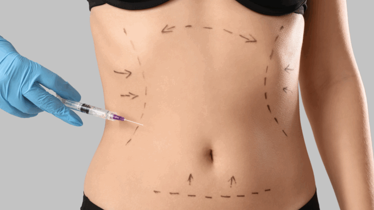 Liposuccion
