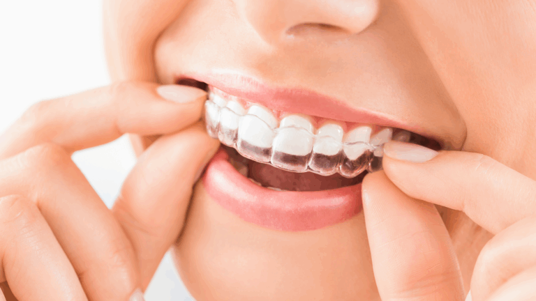 Orthodontie esthetique Orthodontie esthétique