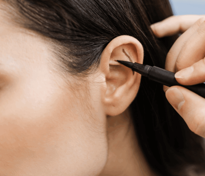 Otoplasty