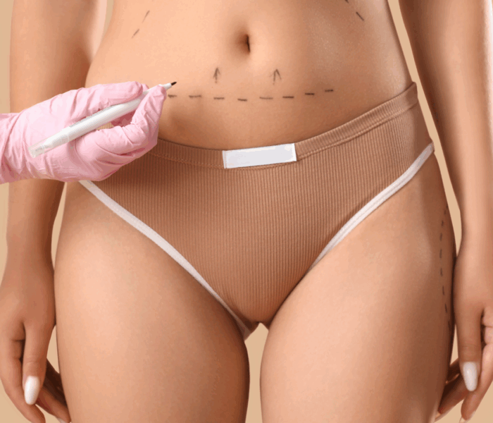 abdominoplastie