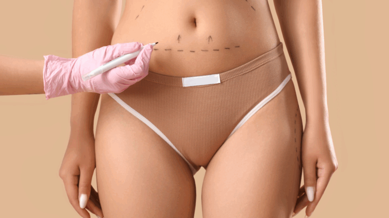abdominoplastie abdominoplastie